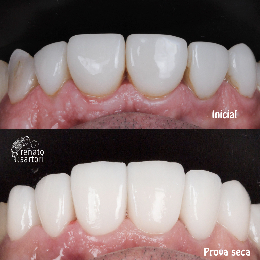 Itaim_Bibi_Lentes_de_contato_dental_itaim_bibi_dentista_vila_olimpia_iguatemi_Dentist_120