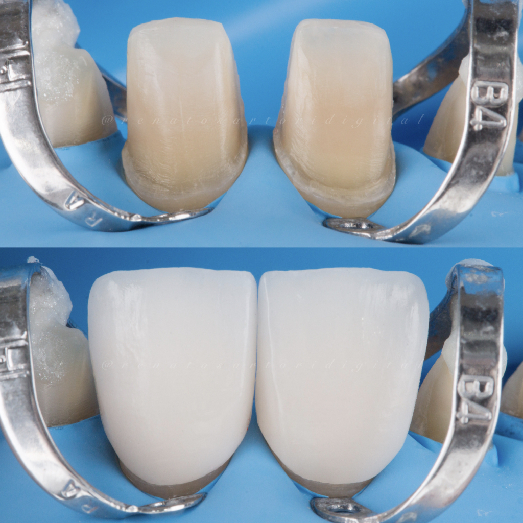 Itaim_Bibi_Lentes_de_contato_dental_itaim_bibi_dentista_vila_olimpia_iguatemi_Dentist_121
