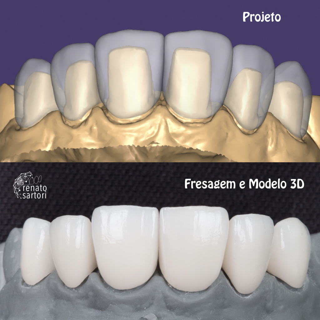 Itaim_Bibi_Lentes_de_contato_dental_itaim_bibi_dentista_vila_olimpia_iguatemi_Dentist_122