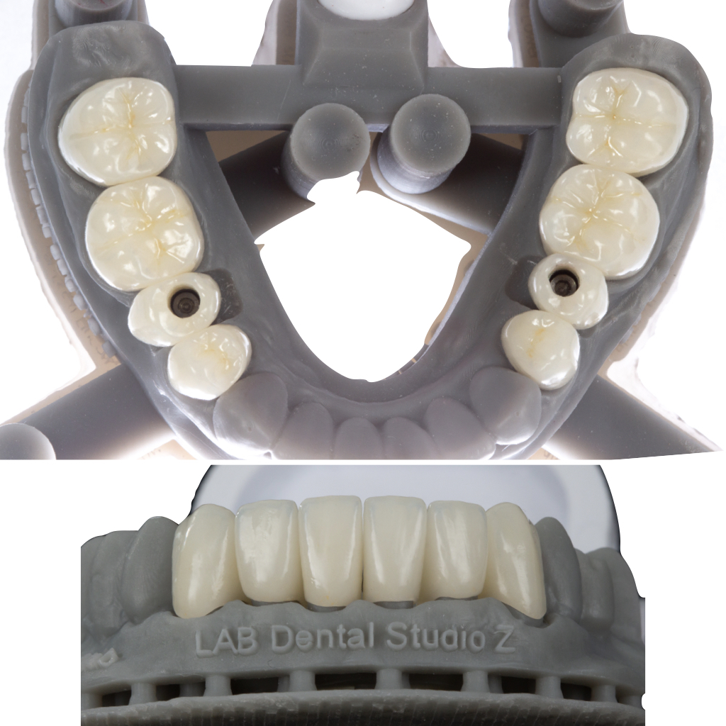 Itaim_Bibi_Lentes_de_contato_dental_itaim_bibi_dentista_vila_olimpia_iguatemi_Dentist_210