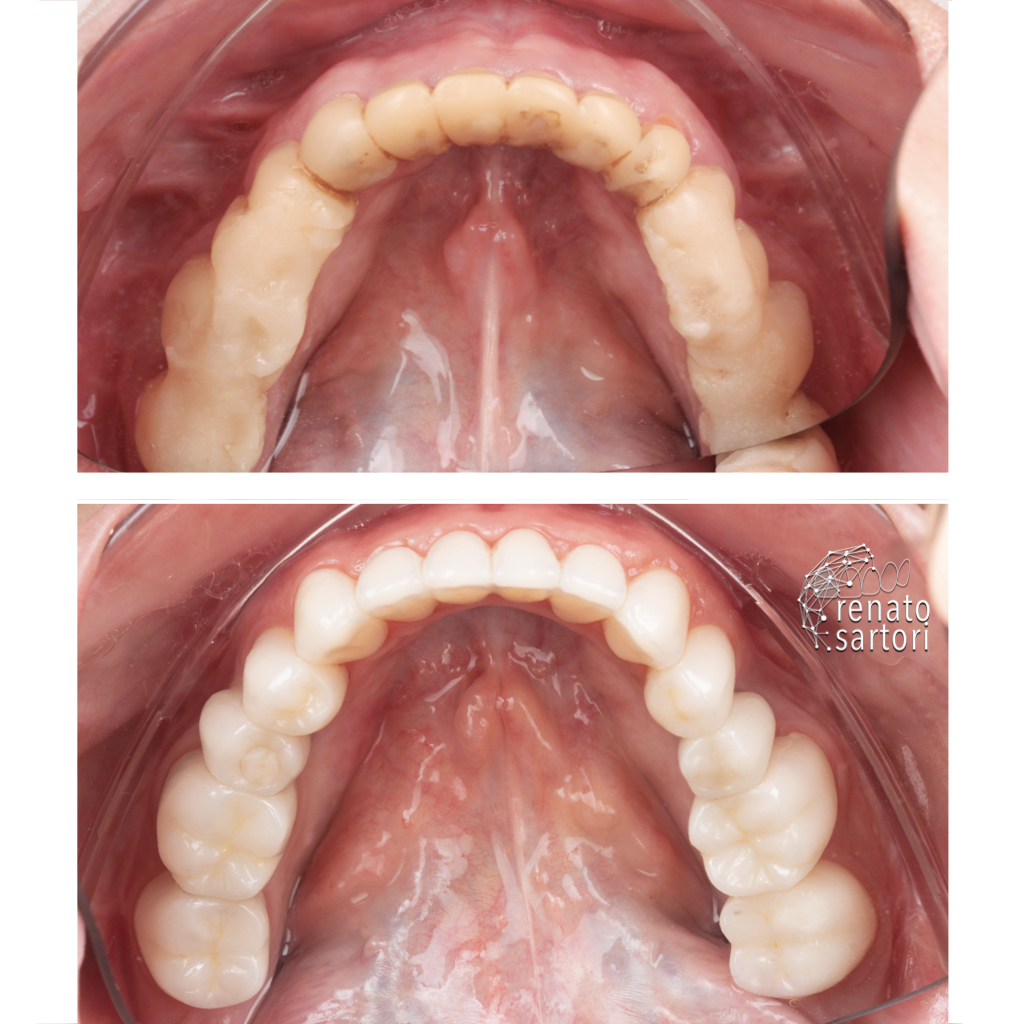 Itaim_Bibi_Lentes_de_contato_dental_itaim_bibi_dentista_vila_olimpia_iguatemi_Dentist_211