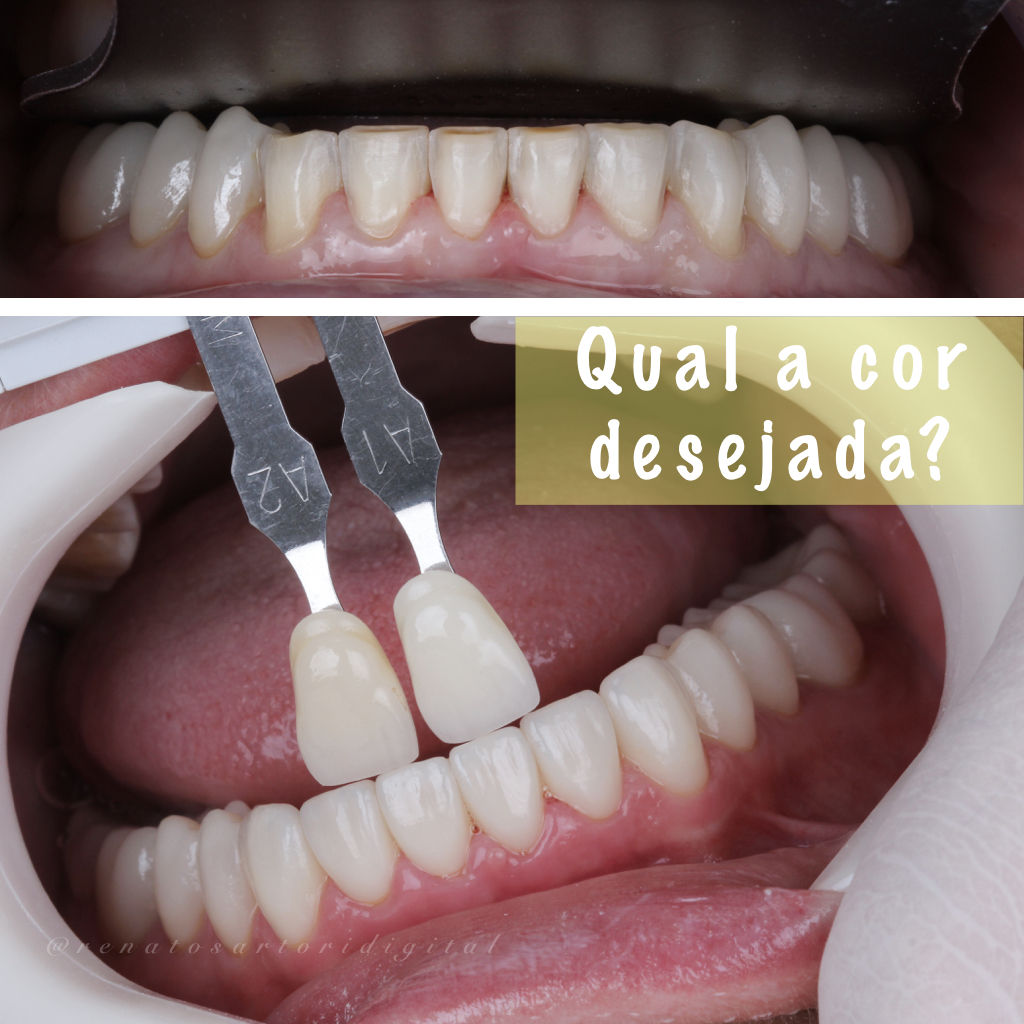 Itaim_Bibi_Lentes_de_contato_dental_itaim_bibi_dentista_vila_olimpia_iguatemi_Dentist_29