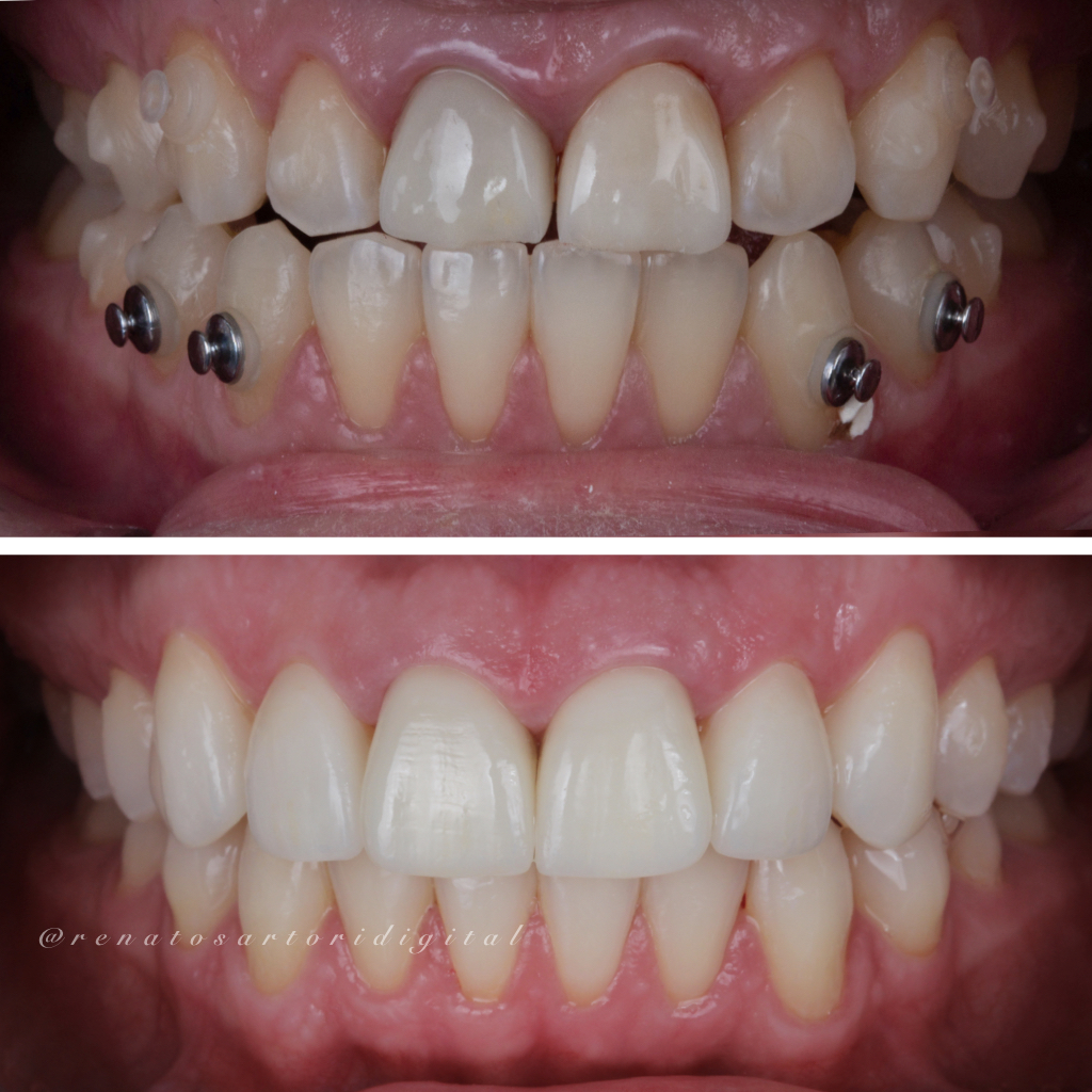 Itaim_Bibi_Lentes_de_contato_dental_itaim_bibi_dentista_vila_olimpia_iguatemi_Dentist_35