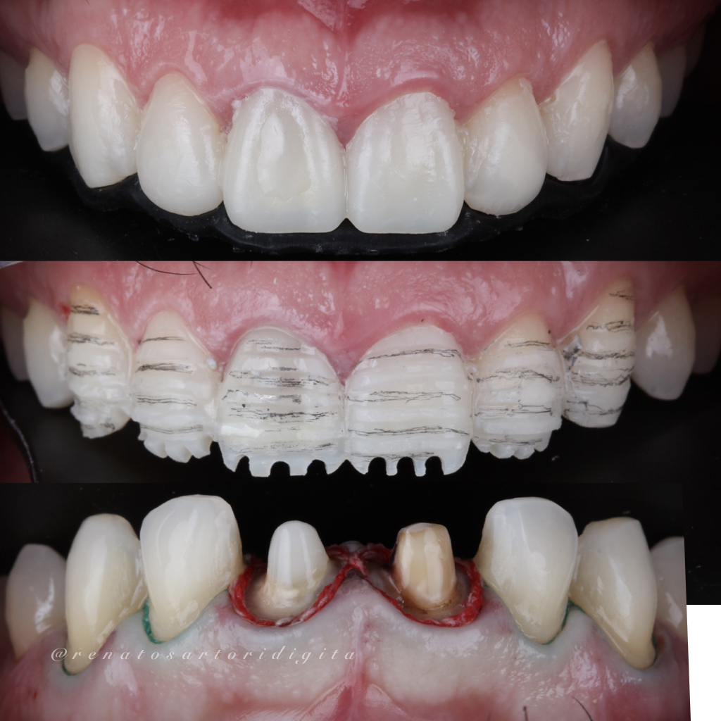 Itaim_Bibi_Lentes_de_contato_dental_itaim_bibi_dentista_vila_olimpia_iguatemi_Dentist_37