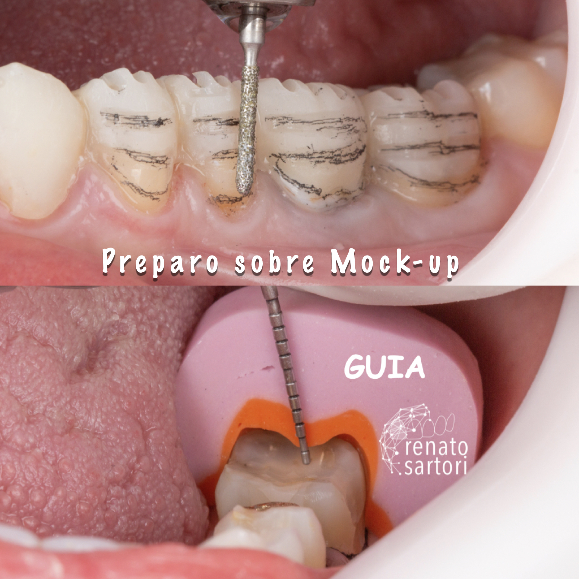 Itaim_Bibi_Lentes_de_contato_dental_itaim_bibi_dentista_vila_olimpia_iguatemi_Dentist_617