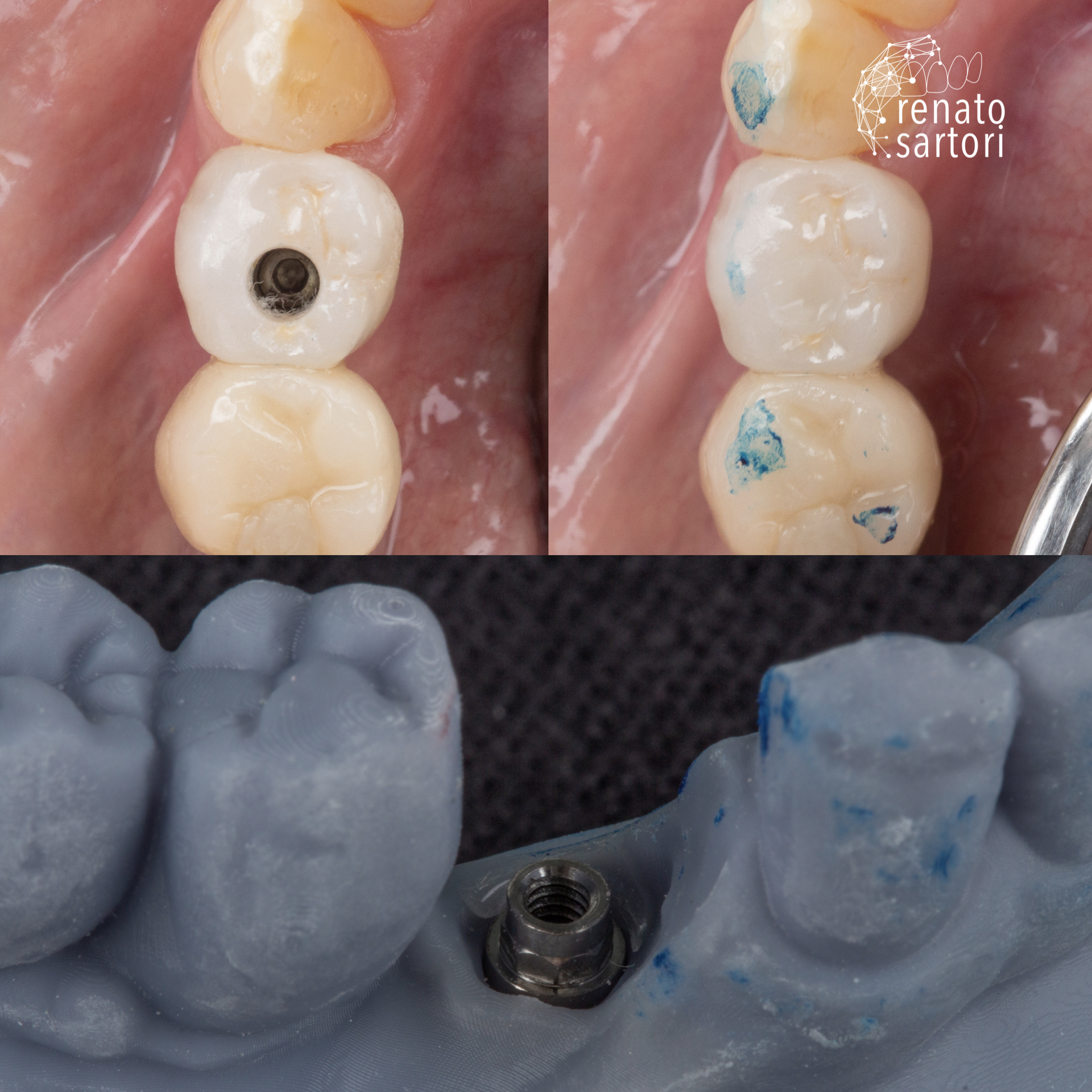 Itaim_Bibi_Lentes_de_contato_dental_itaim_bibi_dentista_vila_olimpia_iguatemi_Dentist_625